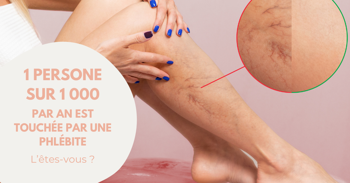 Phlébite profonde ou superficielle, les différences image