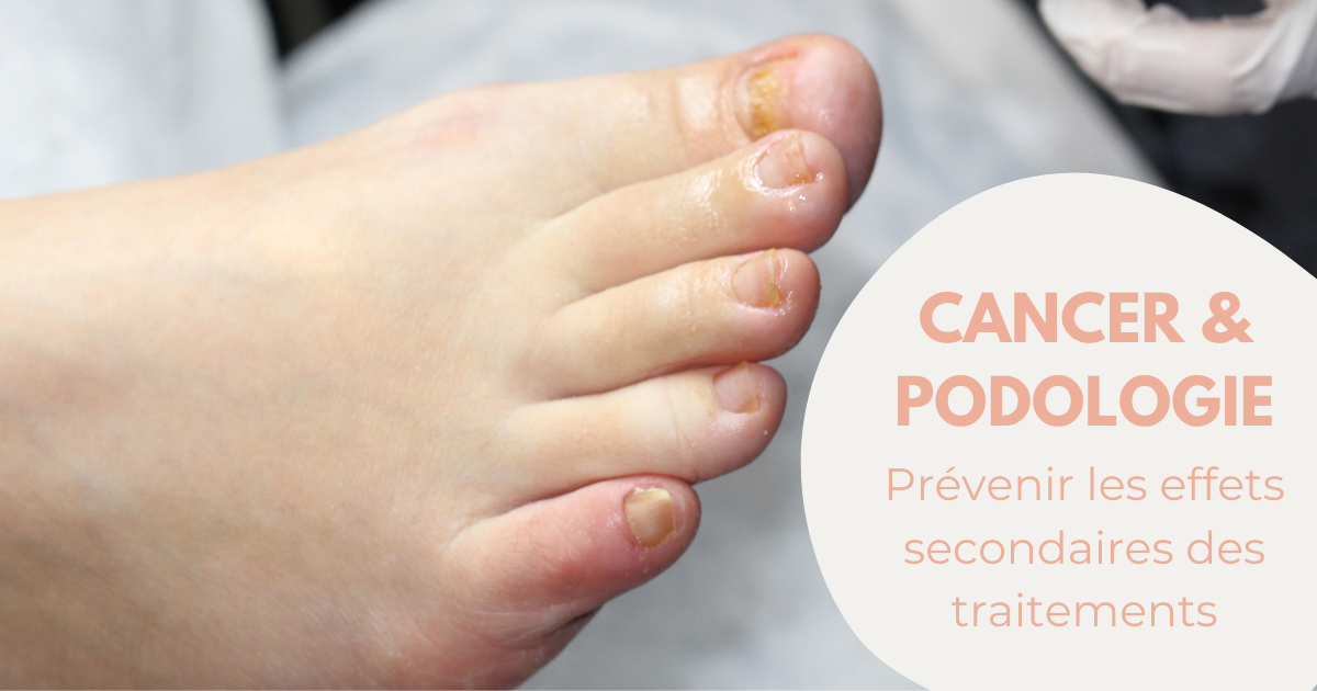Traitements oncologiques, les effets secondaires sur les ongles et les pieds image