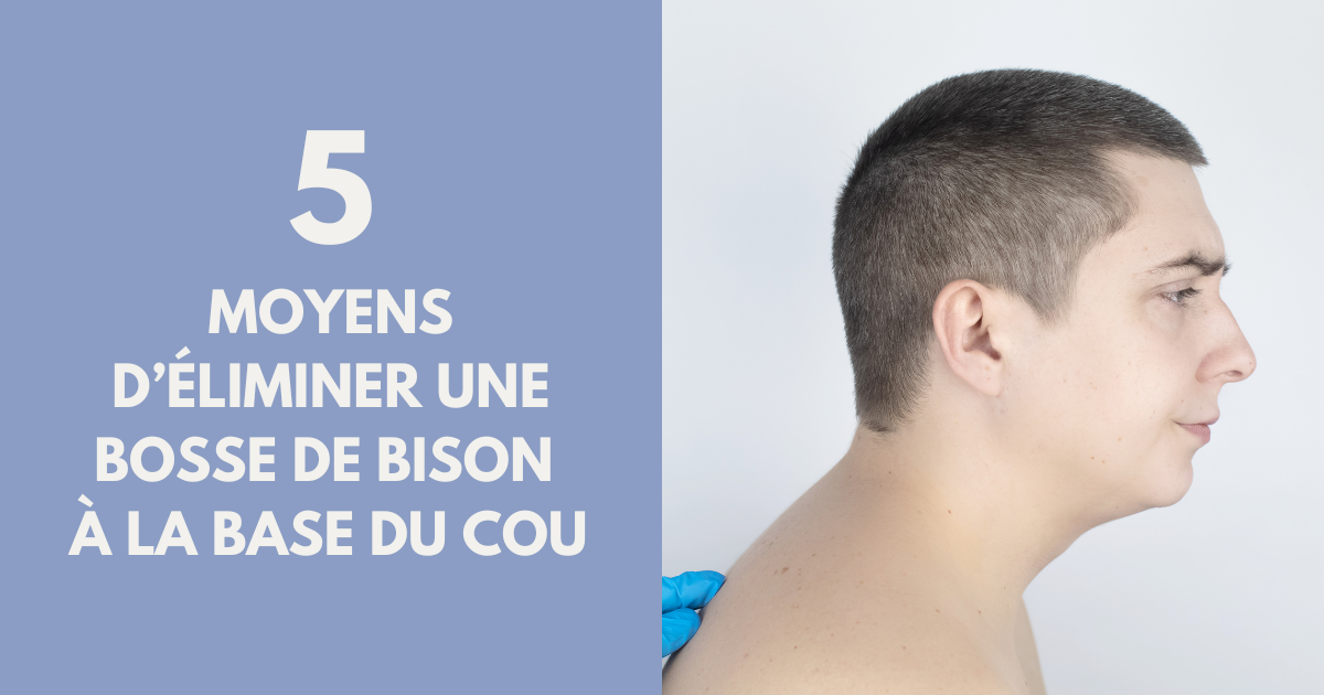 Bosse de bison : Les solutions pour s’en débarrasser ! image