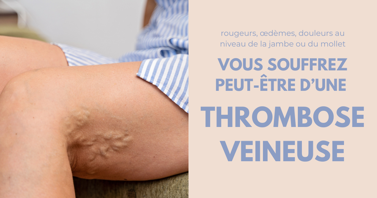 Thrombose, que faire pour soigner cette maladie veineuse ? image