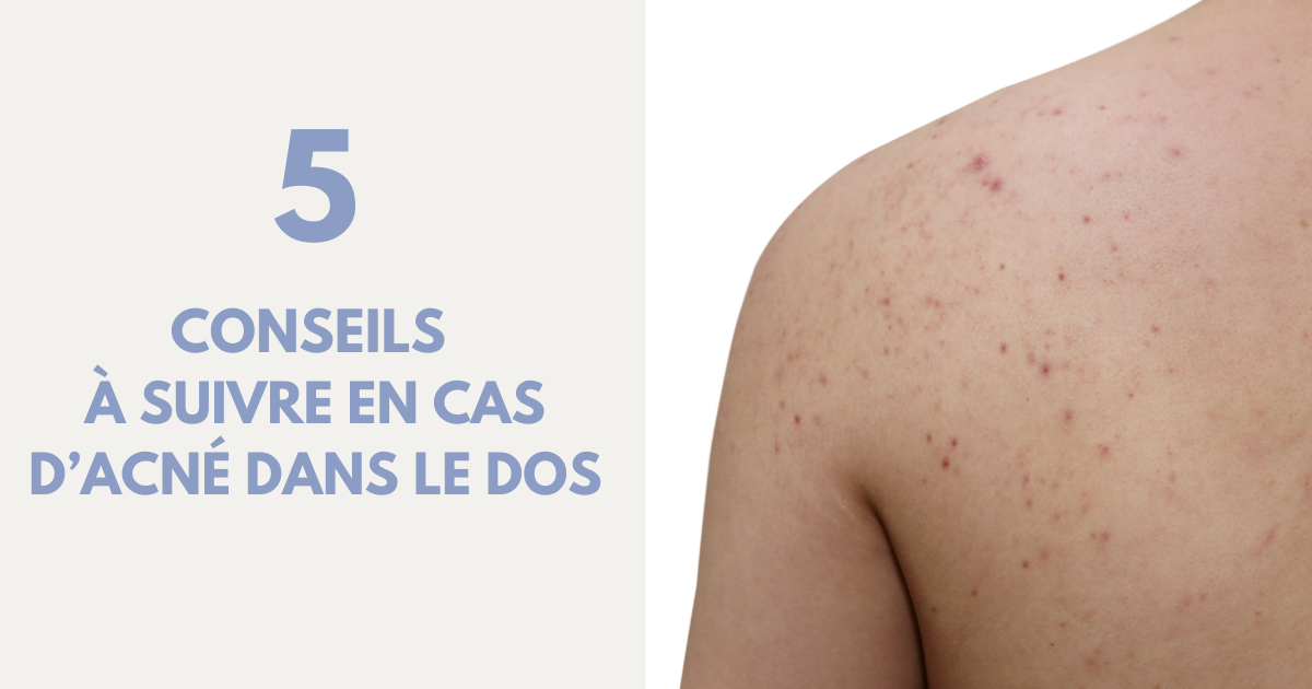 Acné du dos : les bons réflexes pour en venir à bout