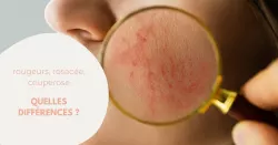 Comment différencier rougeurs, rosacée et couperose ?