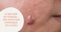 Comment soigne-t-on la maladie de Verneuil ?