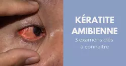 Kératite amibienne, 3 méthodes pour poser un diagnostic