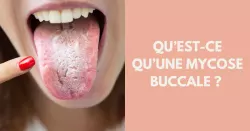 Comment traiter une mycose buccale ?
