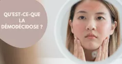 La démodécidose, une affection cutanée rare proche de la rosacée
