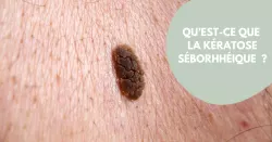 Comment traiter la kératose séborrhéique ?