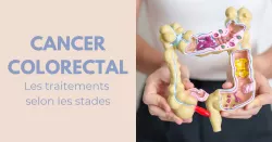 Le cancer colorectal : les recours pour le traiter selon le stade