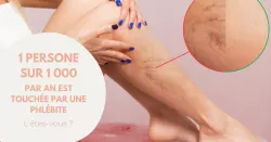 Phlébite profonde ou superficielle, les différences