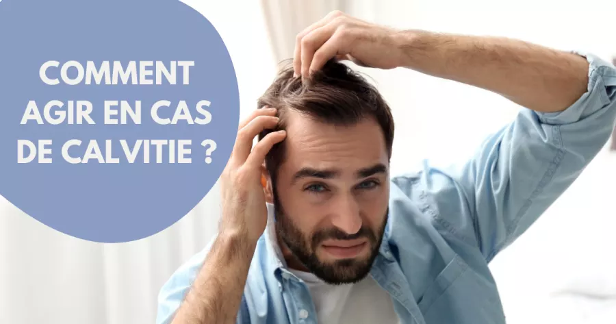 5 traitements contre la calvitie