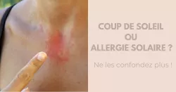 Comment différencier un coup de soleil d’une réaction allergique ?