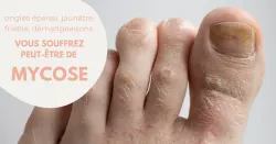 Mycoses des ongles : ne laissez pas le champignon s’installer !