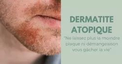 Dermatite atopique : quand les objets du quotidien aggravent les symptômes
