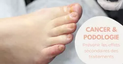 Traitements oncologiques, les effets secondaires sur les ongles et les pieds